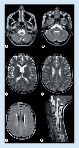 Figure 3. MRI in juvenile Alexander disease.(A) Signal abnormalities in the medulla, (B) the hilus of the dentate nucleus, and (C) a thin periventricular rim. (D & E) Peculiar garland-like structures are present along the ventricular wall. (F) Swelling and prominent signal abnormality of the cervical spinal cord.Reproduced with permission from Citation[75]. Copyright © 2006, Wolters Kluwer Health.