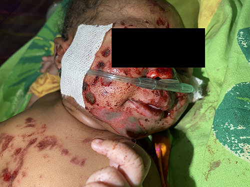 Figure 1 Newborn miraculously surviving being buried alive, displays scattered abrasions and bruises, picture taken in the emergency department post-cleaning from soil and while receiving Oxygen supplementation via Nasal Prongs.