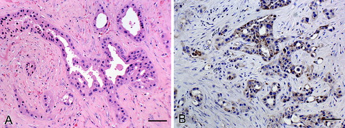 Figure 3. Intestinal adenocarcinoma in a Sika deer characterized by tubules and acini lined by low cuboidal cells in single or multiple layers within a thick hyalinized fibrovascular stroma. (A) Haematoxylin & eosin. Bar = 25 μm. (B) CK20 expression along the cell membranes of intestinal adenocarcinoma cells; detection of CK20 antigen by the biotin-free bond polymer define detection method, counterstained with Mayer's haematoxylin. Bar = 25 μm.