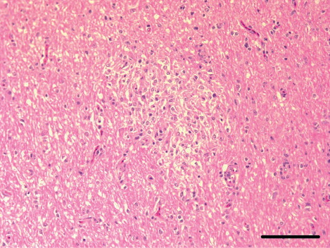 Figure 3. Micrograph of the brain from a meat-type duck showing encephalomalacia and perivascular cuffing in the cerebrum. H&E. Scale bar: 100 µm.