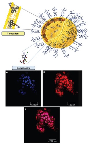 Figure 10 Schematic representation of gemcitabine-tamoxifen localization inside the multidrug carriers (upper panel). Confocal laser scanning micrographs of T47D cells treated with rhodamine-labeled PEGylated unilamellar liposomes after 6 hours of incubation. (A) Hoechst filter, (B) TRITC filter, and (C) overlay (lower panel).Note: © 2012, Elsevier. Reproduced with permission from Cosco D, Paolino D, Cilurzo F, Casale F, Fresta M. Gemcitabine and tamoxifen-loaded liposomes as multidrug carriers for the treatment of breast cancer diseases. Int J Pharm. 2012; 422(1–2):229–237.Citation69Abbreviation: PEG, poly(ethylene glycol).