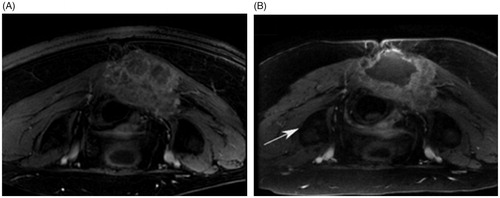 Figure 3. MRI scans in an axial plane demonstrating the sacral chordoma in patient 1. (A) Pre-HIFU treatment MRI scan. (B) HIFU induced necrosis highlighted by the arrow in a post-HIFU treatment MRI scan. Images taken from Gilles et al. [Citation11].
