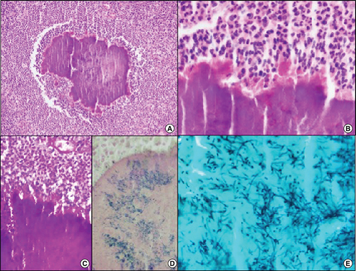 Figure 2. Histological findings of the surgical specimen.(A & B) The clumps of basophilic filamentous bacteria show a rosette-like configuration surrounded by a suppurative mixed inflammatory infiltrate (hematoxylin and eosin [H&E] ×100 and H&E ×400, respectively). (C & D) The bacterial clumps are Gram-positive and PAS- [periodic acid-Schiff] positive (PAS ×200 and Gram ×400, respectively). (E) A Gomori methenamine silver (GMS) stain highlights the filamentous shape of the bacteria (GMS ×1000).