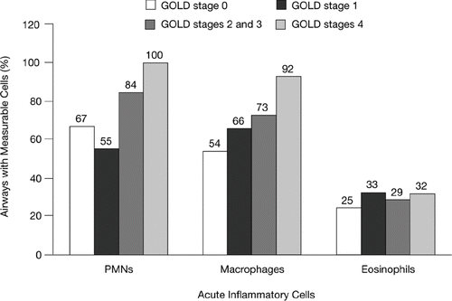 Figure 2 Airway inflammatory response, as measured by the percentage of the airways containing polymorphonuclear neutrophils (PMNs), macrophages, and eosinophils, among patients at each Global Initiative for Chronic Obstructive Lung Disease (GOLD) stage (Citation[4]). Hogg JC, Chu F, Utokaparch S, Woods R, Elliott WM, Buzatu L, Cherniack RM, Rogers RM, Sciurba FC, Coxson HO, Paré PD. N Engl J Med 2004;350:2645–2653. Copyright © [2004] Massachusetts Medical Society. All rights reserved.