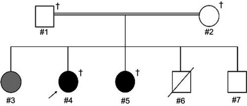 Figure 1 Pedigree of a consanguineous family with two schizophrenia siblings. The female proband (#4), indicated by an arrow, and her younger sister (#5) were diagnosed with schizophrenia, indicated by black shaded symbols. Their older sister (#3) was suspected of having postpartum depression, indicated by a gray shaded symbol. Their parents (#1 and #2) and younger brothers (#6 and #7) were not diagnosed with any psychiatric disorder, indicated by unshaded symbols. Their younger brother (#6) died one day after a Caesarean section delivery, indicated by a diagonal line through the symbol. Their parents (#1 and #2) were second cousins, indicated by a double line between individuals. Squares and circles represent males and females, respectively. Crosses represent individuals from whom genomic DNA samples were available.