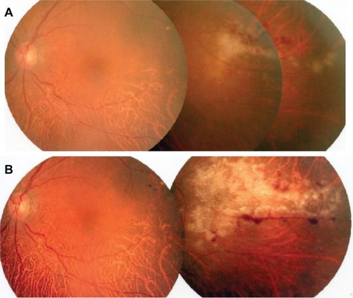 Figure 1 Fundus photographs of the left eye. (A) Whitish retinitis with slight hemorrhage, observed on April 1, 2011. (B) Aggravation of retinitis and hemorrhage on May 6, 2011 (26 days after sub-Tenon injection of triamcinolone acetonide).