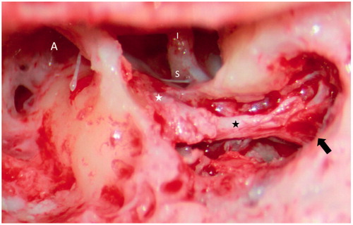Figure 3. A traditional mastoidectomy approach was performed to decompress the facial nerve. Note the junction between the normal-appearing facial nerve and the atrophic or fibrotic part (from the white asterisk to the black asterisk). A black arrow indicates early bifurcation within the mastoid segment. A: antrum; S: stapes; I: incus.