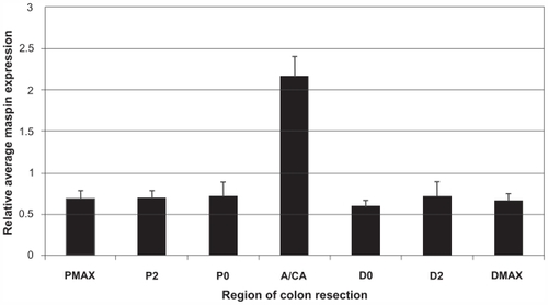 Figure 5 Histogram displaying the average maspin score ± SEM in the non-neoplastic mucosa at different distances from the colonic neoplasms of 10 patients with a large adenoma (A) or cancer (CA). Samples of the non-neoplastic mucosa were taken adjacent to the tumor on the proximal and distal sides (P0, D0), 2 cm away on the proximal and distal side (P2, D2) and near the surgical margins (PMAX, DMAX).