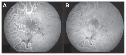 Figure 2 Early (A) and late (B) phases of fundus fluorescein angiography of the left eye showing macular ischemia and extensive arteriovenous communications and dilated intertwined vessels. There are small hemorrhages and exudates and white (sheathed) vessels in the macular area.