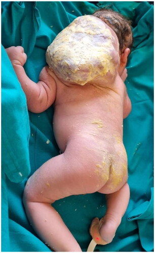 Figure 1. Postnatal appearance of the newborn with a giant congenital hemangioma located in the posterior side of the neck.