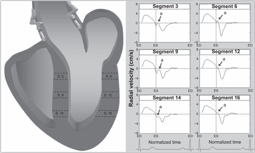 Figure 5 Schematic representation of the effect of reflected wave propagation on ventricular segments, demonstrating a greater influence of reflected aortic pressures waves on septal segments which are in continuity with the aorta, compared with lateral segments which are not in direct continuity. The arrows (a) shows an upright notch in early diastole corresponding to propagation of the reflected wave on left ventricular segments. The graphs represent average values for all volunteers. Positive values show inward motion toward the center of the ventricle, while negative values show outward expansion.