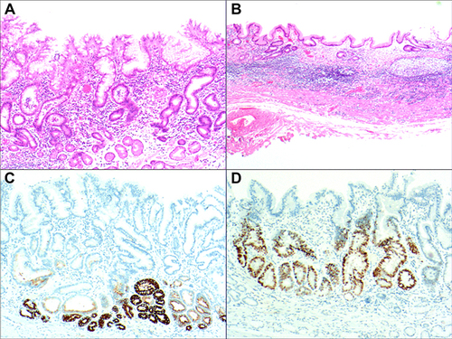 Figure 5 Insufficient downward migration of the stem cells in the proliferative region. (A) Proliferative disorder of the proliferative region, reduction in the number and size of glands in the lamina propria; H&E staining, ×200. (B) Almost complete disappearance of the glands in areas with severe atrophy, with only a thin layer of surface mucus cells, hyperplasia of the fibrous connective and smooth muscle tissue, and hyperplasia of lymphoid tissue; H&E staining, ×100. (C) Positive for MUC6, EnVision method, ×200. (D) Positive for p53, EnVision method, ×200.