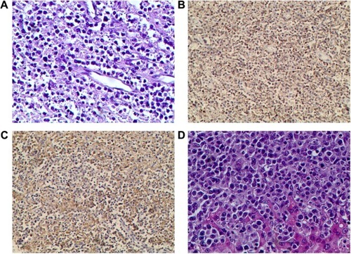 Figure 5 Histological findings of the ulcerated mass and liver biopsy.