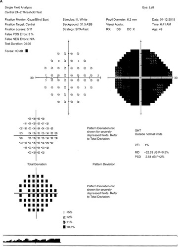 Figure 1 Humphrey visual field test showed normal visual field in the right eye (A) and diffuse depression of visual field in the left eye (B).