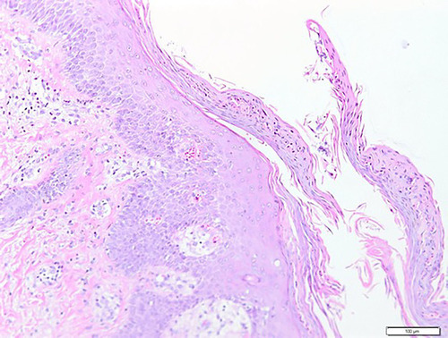 Figure 3 Histopathological findings (H&E staining 100x). Histopathological results revealed hyperkeratosis, parakeratosis, and Munro’s microabscess.