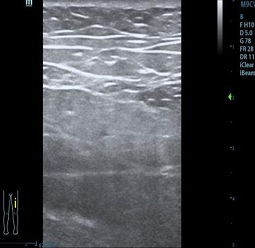Figure 4 Ultrasound screenshot of lower limb muscles.