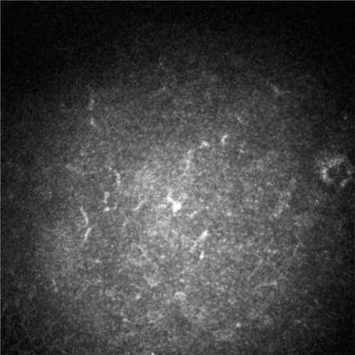 Figure 5 Confocal microscopy image 3 months after the injection.