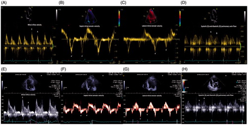 Figure 3. (A–H) Illustrations showing Doppler of mitral inflow, tissue-Doppler of both basal-septal LV and basal-lateral LV and Doppler of pulmonary vein flow for patients stratified for S/D ratio ≥1 (3A–D) and for patients with S/D ratio <1 (3E–H). Traces of mitral inflow, tissue-Doppler both septal and lateral and pulmonary vein flow in a patient with normal diastolic function and normal S/D ratio >1(A–D) and a patient with a grade II–III diastolic dysfunction and a decreased S/D ratio <1(E–H).