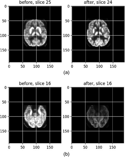 Figure 6. The normalization (a) and registration (b) images before and after treatment, with the anterior cortex used as the reference.