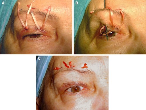 Figure 2 Eyelid-brow suspension with fascia lata.