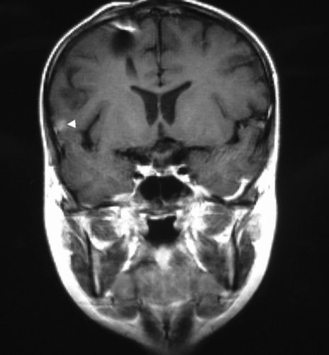 Figure 2.  111In-pentetreotide scintigraphy (A) and MRI (B) of patient number eight demonstrate a potential source of false positive SRS imaging. The sagittal SPECT image (A) shows a slightly increased tracer uptake diffuse in the occipital and sub-occipital area (arrows), while the MRI (B) depicts only postoperative defects and a clip artefact (arrow) after primary tumor resection but no sign of tumor recurrence. This form of unspecific tracer uptake is most likely caused by regenerative processes after surgery and radiation.