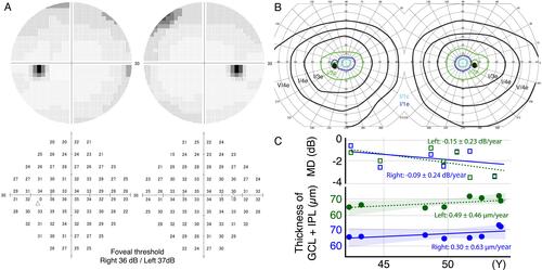 Figure 2 Visual field testing and retinal thickness. (A) Humphrey visual field testing showing slight relative visual field defects in both eyes. The foveal thresholds are within the normal range. (B) Kinetic visual field testing showing no obvious abnormalities in all isopters. (C) The change of median deviation (MD) in Humphrey field analyzer and averaged thickness of ganglion cell layer (GCL) and inner plexiform layer (IPL) in optical coherence tomography images showing no progressive change as glaucoma during the time course of 12 years.