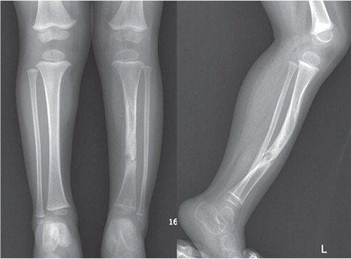 Figure 1. A. Anteroposterior and lateral radiographs from a 6-year-old boy with Boyd type-I congenital pseudoarthrosis of the tibia.