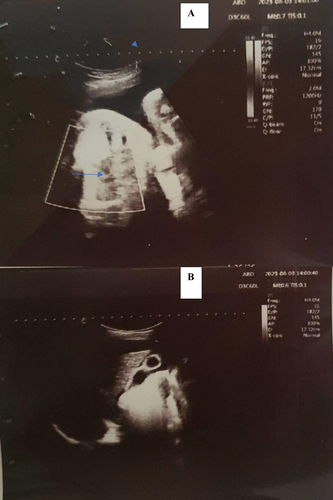 Figure 1 Abdomino-pelvic ultrasound, 25 years old pregnant lady at 33 weeks gestation with spontaneous hemoperitoneum due to rupture of uterine vessels.