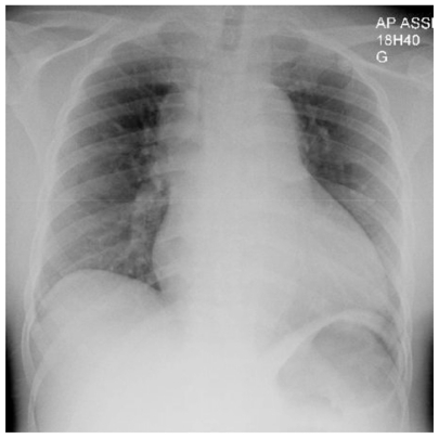 Figure 1 Antero-posterior chest X-ray of our patient at his initial presentation.
