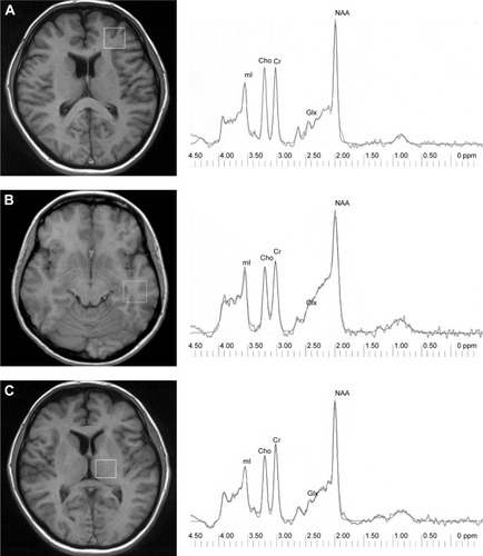 Figure 1 Voxel location: left frontal lobe (A), left temporal lobe (B), left thalamus (C), and 1H spectrum – raw and fitted data for each region.