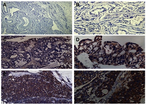 Figure 1 The expression of DYNLT3 protein in different ovarian epithelial lesions. (A) Image of staining with DYNLT3 in normal ovarian epithelial tissue (×100). (B) Image of staining with DYNLT3 in normal ovarian epithelial tissue (×400). (C) Image of staining with DYNLT3 in ovarian serous cystadenoma tissue (×100). (D) Image of staining with DYNLT3 in ovarian serous cystadenoma tissue (×400). (E) Image of staining with DYNLT3 in ovarian serous cystadenocarcinoma tissue (×100). (F) Image of staining with DYNLT3 in ovarian serous cystadenocarcinoma tissue (×400).