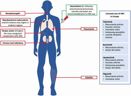 Figure 2. Serious infections associated with JAK inhibitors.Based on the summary of product characteristics, the commonest infections associated with Janus Kinases (JAK) inhibitors are: upper respiratory tract infections, pneumonia, Mycobacterium tuberculosis, herpes zoster, urinary tract infections and cellulitis. The right panel shows the licensed clinical uses of JAK inhibitors in Europe according to the European Medicines Agency (EMA) at the time of publication.