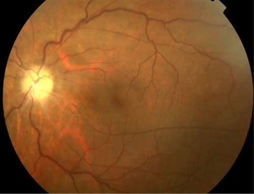 Figure 5 Fundus photograph of the left eye of a patient with a history of rickettsial infection shows optic disc atrophy secondary to ischemic optic neuropathy.