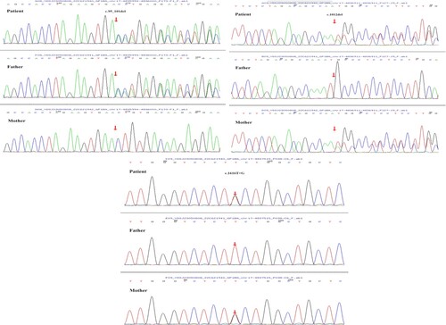 Figure 1. Sanger sequencing of GPI bα exons in the present case and her parents. (a) The patient had a heterozygous mutation of c.95_101del in chr17:4835994-4836000, father had a heterozygous mutation of c.95_101del, and mother had no mutation. (b) The patient had a heterozygous mutation of c.1012del in chr17:4836911-4836911, father had no mutation, and mother had a heterozygous mutation of c.1012del. (c) The patient had a heterozygous mutation of c.1616T>G in chr17:4837515, father had no mutation, and mother had a heterozygous mutation of c.1616T>G.