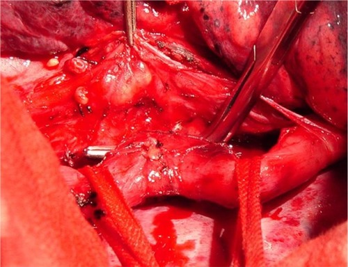Figure 3 The location of the esophagotracheal fistula is determined during the operation.