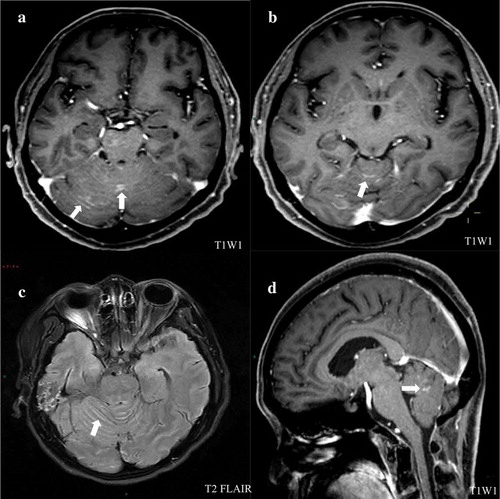 Figure 3. Head magnetic resonance imaging (MRI) scans from patient. (a) and (b) an enhanced T1-weighted imaging (T1WI) images demonstrated abnormal hyperintense signal representing leptomeningeal metastatic disease in the cerebellar folia. (c) Axial T2 fluid-attenuated inversion recovery (FLAIR) images of leptomeningeal showing the same enhancement. (d) Sagittal postcontrast T1-weighted images demonstrated the evidence of metastases in leptomeningeal.