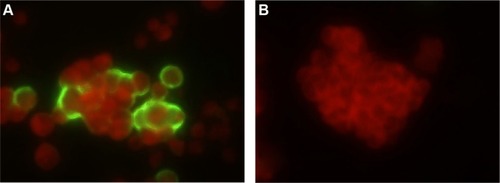 Figure 4 Detection of adenovirus in the HEp-2 cells derived from swab samples of patients by indirect immunofluorescence assay. The cytoplasm and nuclei were stained red by Evans blue, and green fluorescent signals were on adenovirus-infected cells.