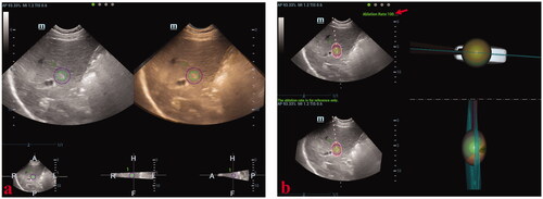 Figure 5. These photographs show simulated-needle placement performed in a liver tumor with the largest diameter of 10 mm by three-dimensional ultrasound fusion image (3DUS-FI). (a) The safety margin of the tumor of 5 mm was outlined for 3 D tracing by two concentric spheres in different colors (the radius difference was 5 mm). Real-time two-dimensional ultrasound (2DUS) images (left) and three-dimensional ultrasound (3DUS) volume images (right) were registered efficiently. (b) Real-time 2DUS images (upper left), 3DUS volume images (lower left), three-dimensional (3 D) views of the coronal plane (upper right) and lateral (lower right) of the tumor were simultaneously displayed on a screen. When the patient held the breath at the end of inspiration (with the same respiratory phase while acquiring 3DUS volume images of the tumor), the largest plane and the real-time center point of the tumor could be observed to guide needle placement. The virtual ablation needle was placed at the center of the tumor to achieve complete overlapping between the ablation zone and the tumor with a 5-mm safety margin. When the virtual ablation needle was placed, the simulated ablative cover rate was automatically displayed on the screen in real-time (red arrow).