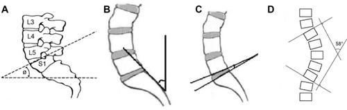 Figure 1 Measurement of geometric angles of the lumbosacral spine.