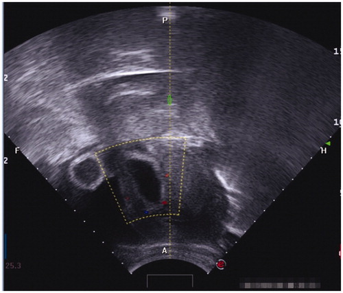 Figure 1. Gestational sac implanted in the previous caesarean scar with empty uterus cavity and cervical canal; no myometrium was visible between the bladder and the sac.