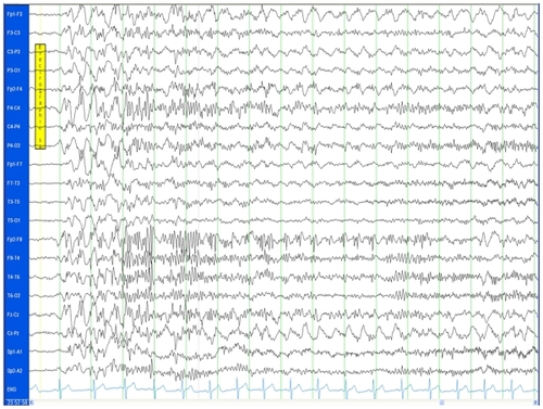 Figure 3C An EEG time segment during sleep showing generalized polyspike wave.