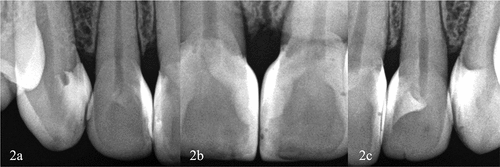 Figure 2. Clinical case 1. Two weeks radiographic control composition to check the adaptation and the absence of retentive areas, the radiopacity of the composite allows us to observe the new artificial amelocementary junctions proximally. (a) Adaptation of composite in the papilla area from right mesial upper canine to distal upper right central incisor. (b) Good composite adaptation between centrals incisors drawing the new natural emergence profiles. (c) Adaptation of composite in the papilla area from left distal upper central incisor to mesial upper left canine.