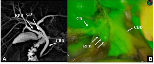 Figure 1 MRCP shows the cystic duct (CD) entering the right posterior branch (RPB) (A). The course of bile duct was confirmed by fluorescence after the intravenous injection of ICG. The CD running from the RPB and common hepatic duct (CBD) was confirmed (B).
