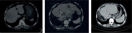 Figure 9 Patient #12 presented with single large tumor in September 2013 (shown in the left panel), which was removed surgically. In January 2014, multiple new lesions appeared in left lobe, which were not amenable to surgical intervention (panel in the center). At this time, his AFP concentration was extremely high (92,407 IU/mL)—no one in our entire cohort of 75 patients had more than that. In September 2014, the patient’s AFP levels reduced to 2.3 IU/mL and there were no visible lesions on CT scan (right panel). Between January and September, the patient received V5 intermittently for a total of 7 months. The patient is still alive and doing well.
