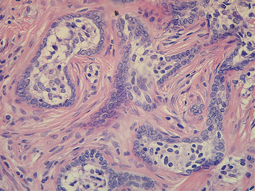 Figure 3 The lobules had a peripheral rim of 1 or 2 layers of basaloid cells, central RS-L cells, and lymphocytes infiltration around. (Magnification ×10).