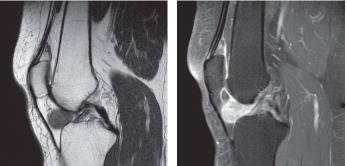 Figure 2. MRI of TGCT localized-type, extremity: sagittal T1-weighted turbo spin echo MRI of a 47-year-old female patient, affecting her right knee. A well-circumscribed lesion in Hoffa’s fat pad is seen. Left panel: Proton density weighted MRI. Right panel: Pre-saturation inversion recovery MRI.