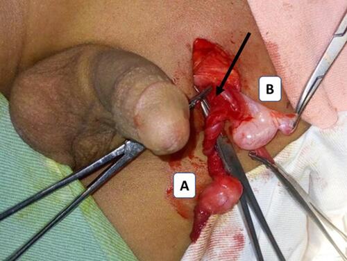 Figure 1 Intraoperative picture; left polyorchidism with a separate epididymis and common vas deferens. Caudal testis (A), cranial testis (B), common vas (black arrow).