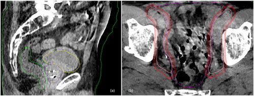 Figure 1. Illustration of the motion between the initial CBCT and the verification CBCT with organ delineations (bladder in yellow, rectum in light green, prostate in purple and seminal vesicles in dark green) from the initial CBCT overlaid on the verification CBCT (a), and of the PTV expansions of the pelvic lymph nodes with CTV in pink and PTV with 3, 4 and 5 mm margin in red (b).