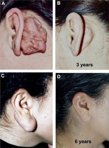 Figure 4 Result at baseline (A and C) and after 3 and 6 years, respectively (B and D) post-intralesional cryotherapy.Adapted with permission from Har-Shai Y. Intralesional cryosurgery for enhancing the involution of hypertrophic scars and keloids. A new effective technology based on experimental and clinical data. Journal of wound Technology. 2012;15:8–9.Citation118