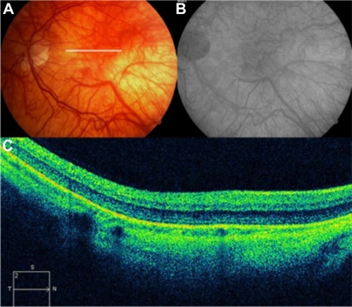 Figure 58 Foveal hypoplasia in albinism.